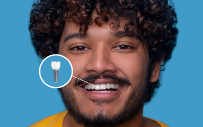 Implantes Dentários