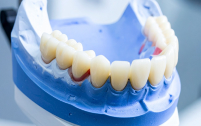 Sorriso renovado: As alternativas em próteses e implantes